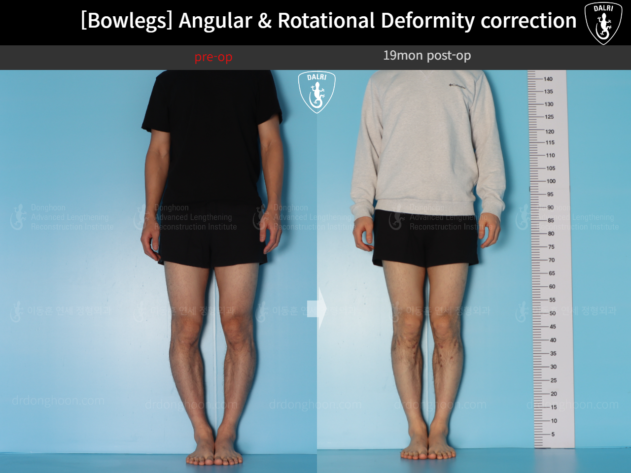 Before and after adult bowlegs, case 18306379, image 2, Dr. Donghoon institute (DALRI)