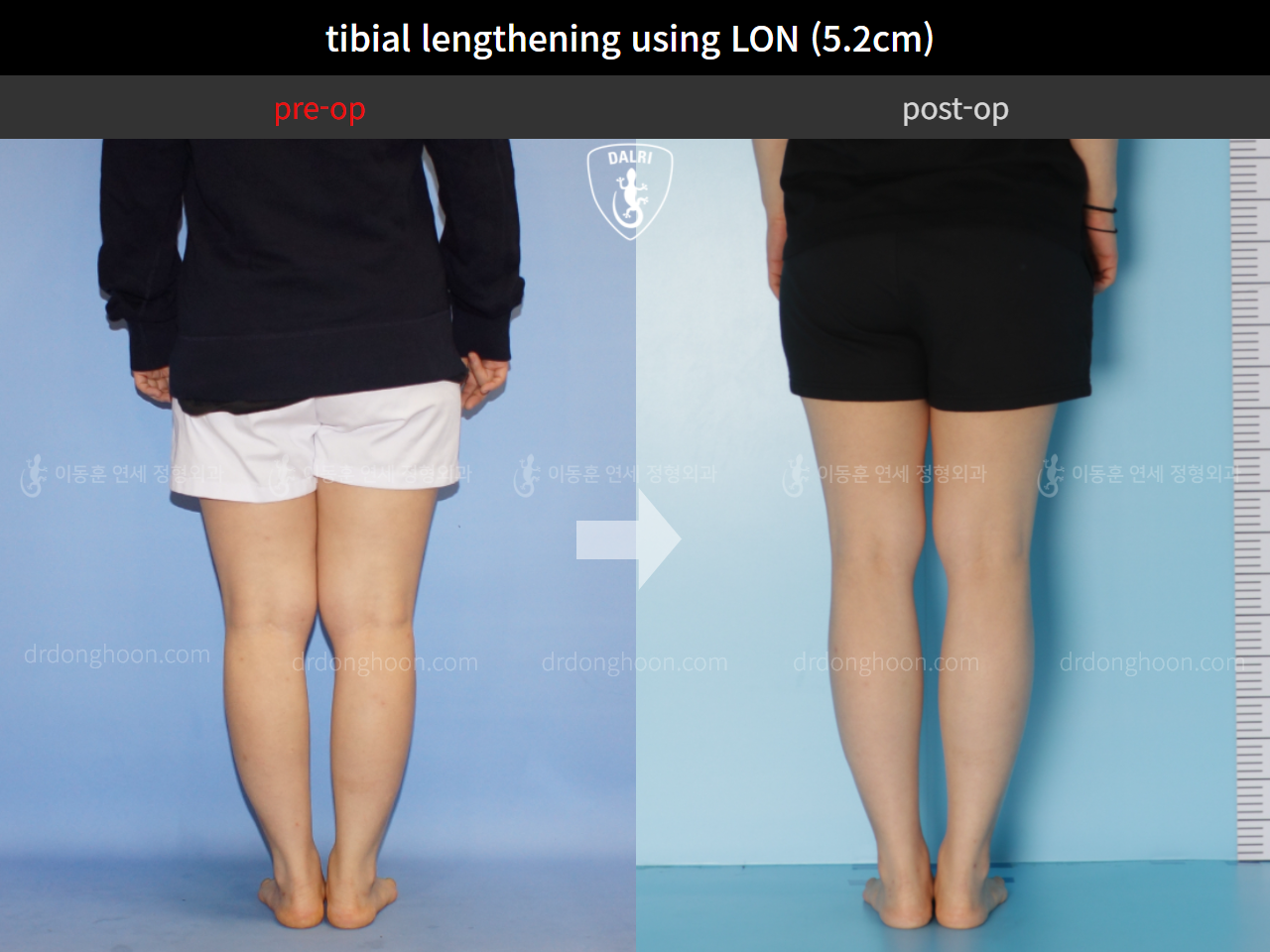 Before and after cll lon, case 4860933, image 6, Dr. Donghoon institute (DALRI)