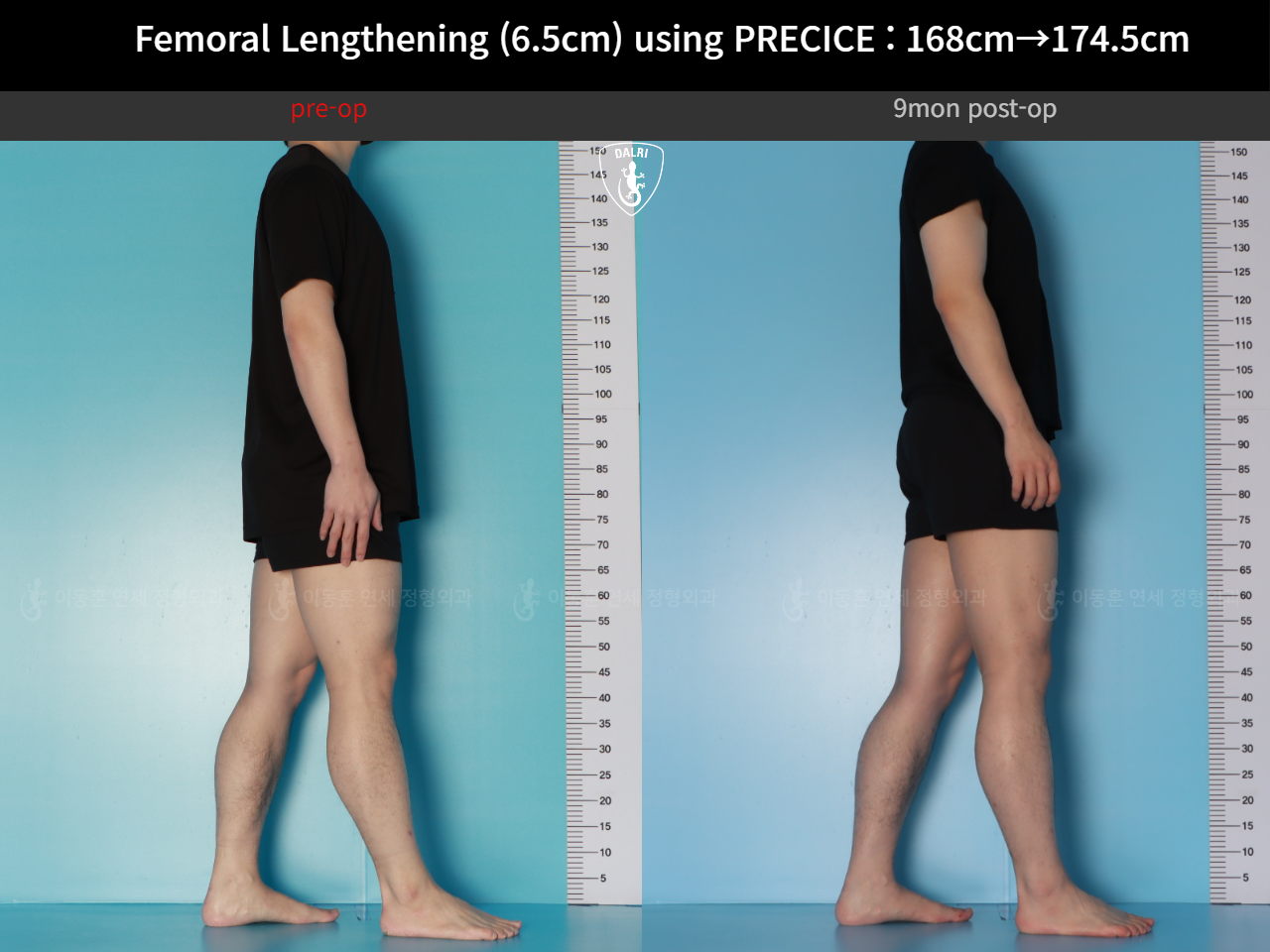 Before and after cll precice, case 123911358, image 5, Dr. Donghoon institute (DALRI)