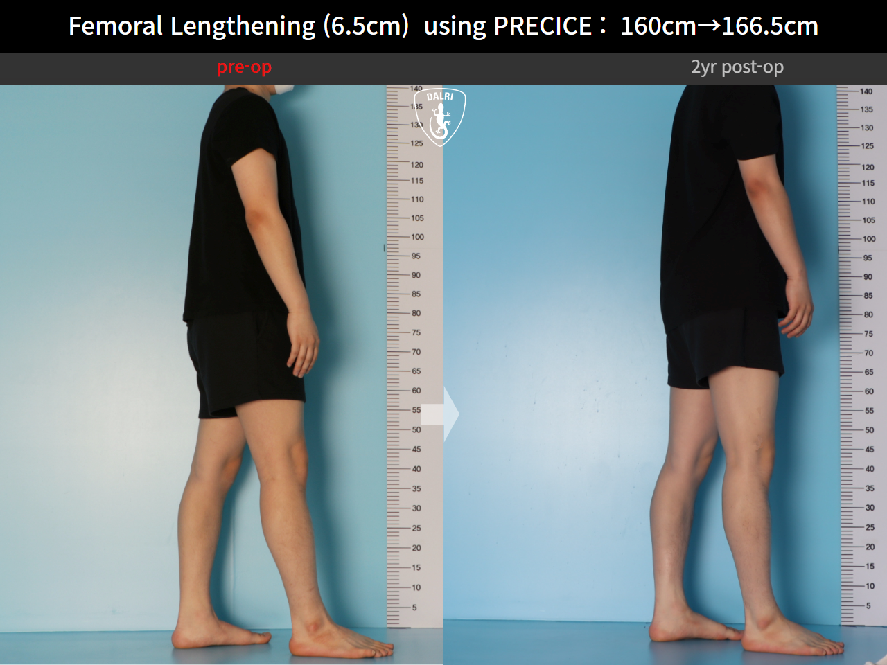 Before and after cll precice, case 27369651, image 5, Dr. Donghoon institute (DALRI)