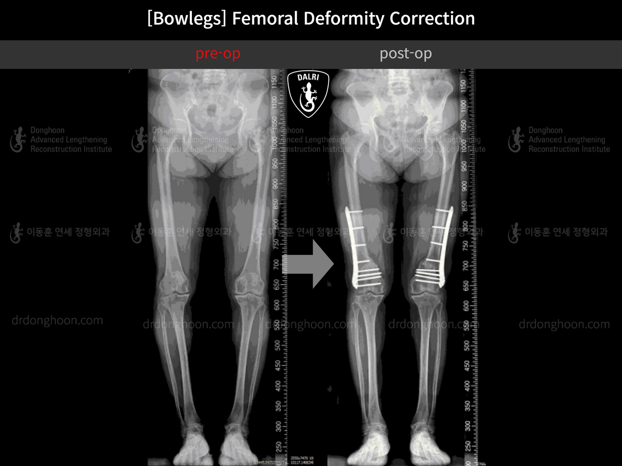 Before and after adult bowlegs, case 12791222, image 7, Dr. Donghoon institute (DALRI)