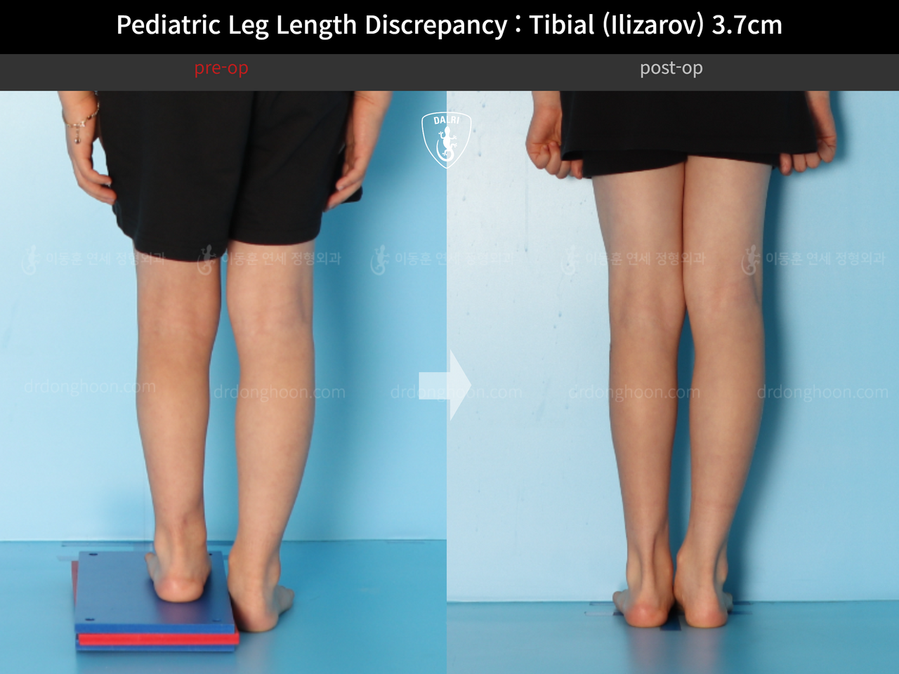 Before and after paediatric & adolescent lld, case 14220900, image 6, Dr. Donghoon institute (DALRI)