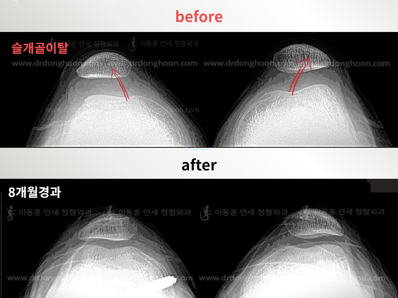 Before and after recurrent patella dislocation, case 4594104, image 1, Dr. Donghoon institute (DALRI)
