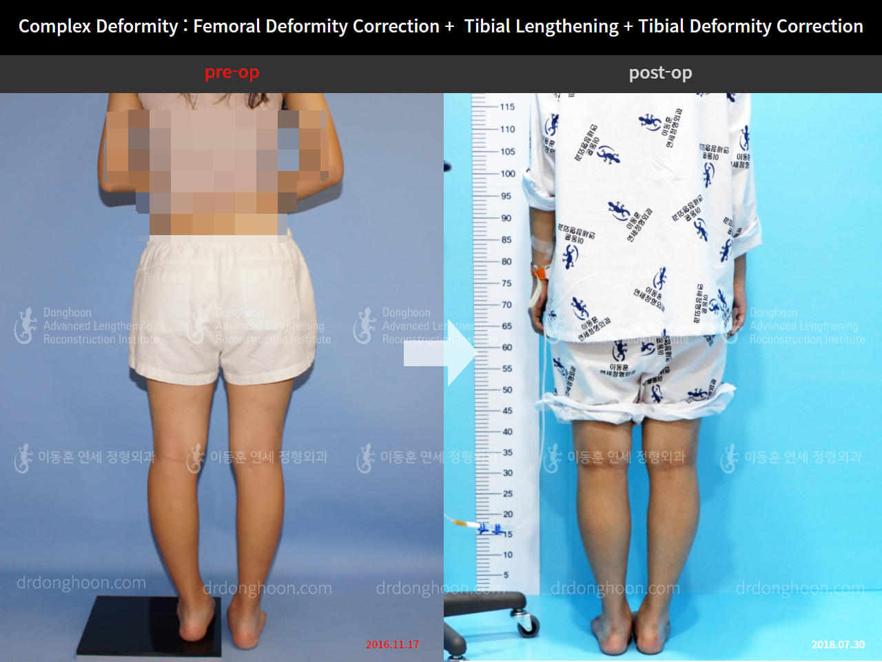 Before and after adult lld, case 4320351, image 3, Dr. Donghoon institute (DALRI)
