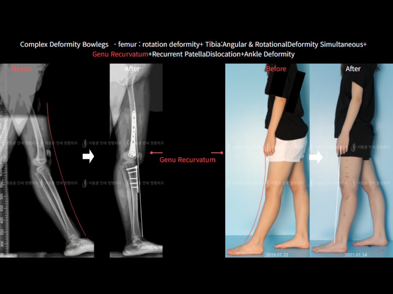 Before and after complex deformity, case 6883057, image 3, Dr. Donghoon institute (DALRI)