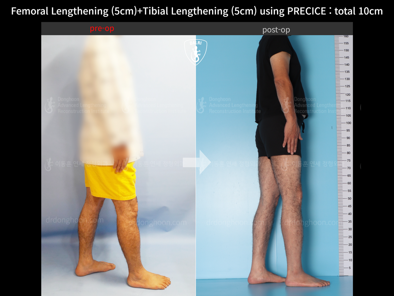 Before and after cll precice, case 13390688, image 4, Dr. Donghoon institute (DALRI)