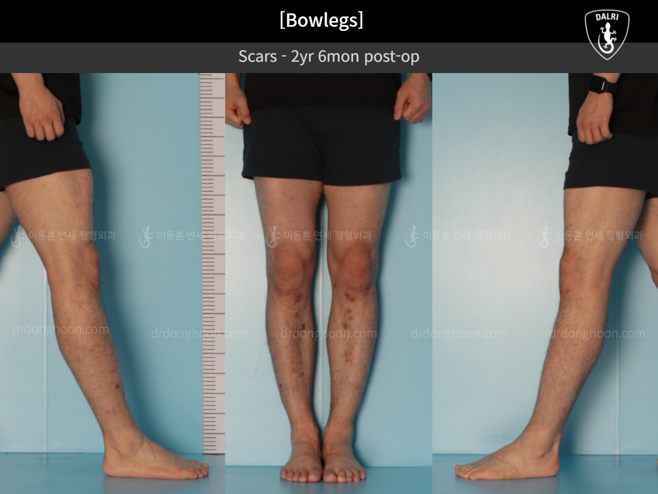 Before and after adult bowlegs, case 11037119, image 7, Dr. Donghoon institute (DALRI)