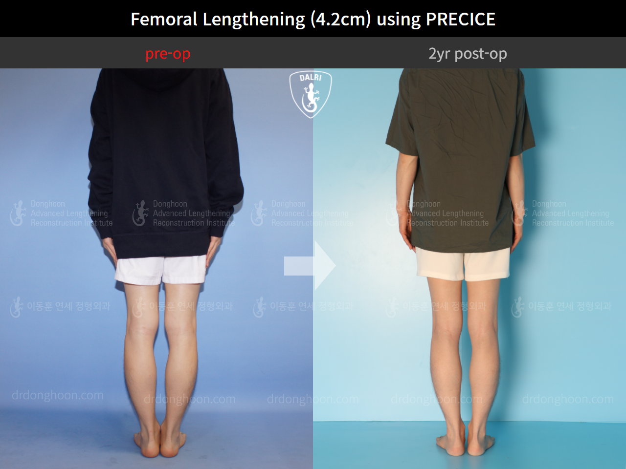 Before and after cll precice, case 4323396, image 2, Dr. Donghoon institute (DALRI)