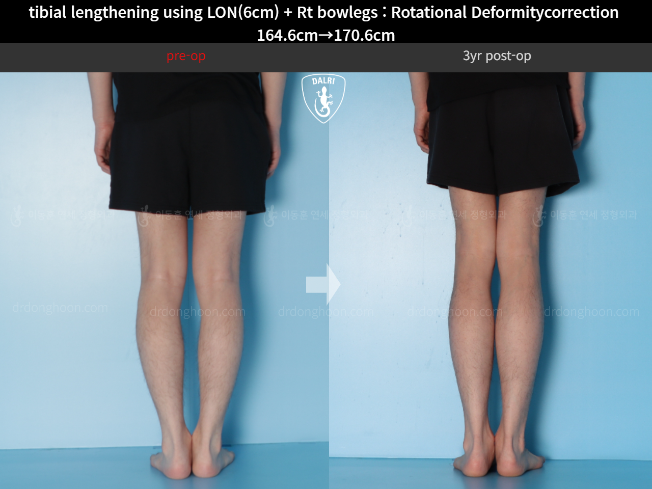Before and after cll + deformity correction, case 15347322, image 7, Dr. Donghoon institute (DALRI)