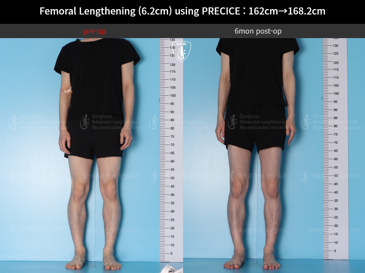 Before and after cll precice, case 15393865, image 2, Dr. Donghoon institute (DALRI)