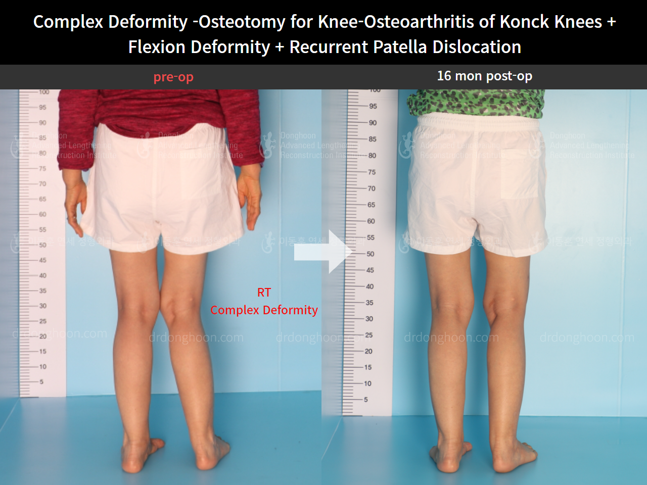 Before and after recurrent patella dislocation, case 8580605, image 2, Dr. Donghoon institute (DALRI)