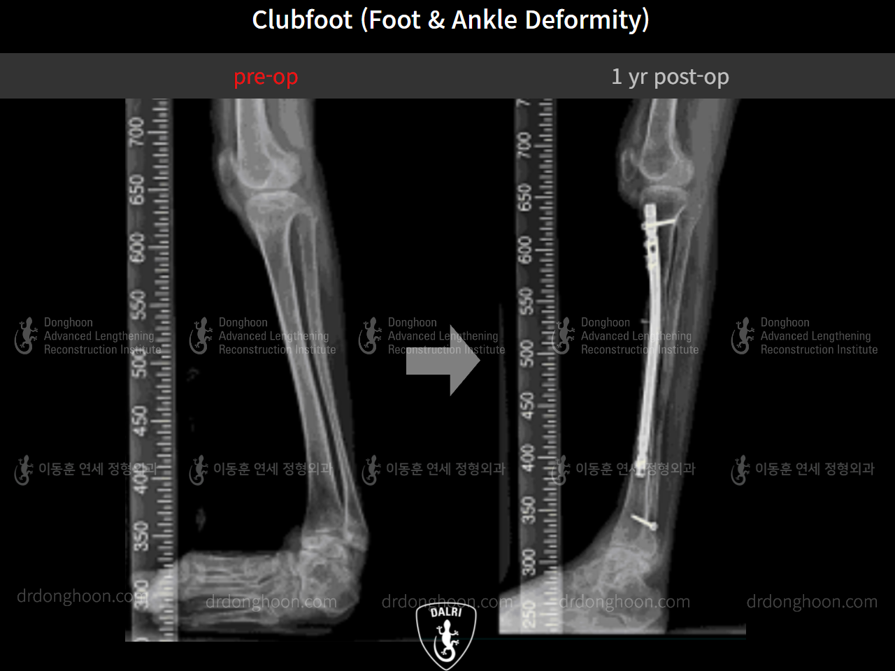 Before and after congenital condition, case 9231521, image 14, Dr. Donghoon institute (DALRI)
