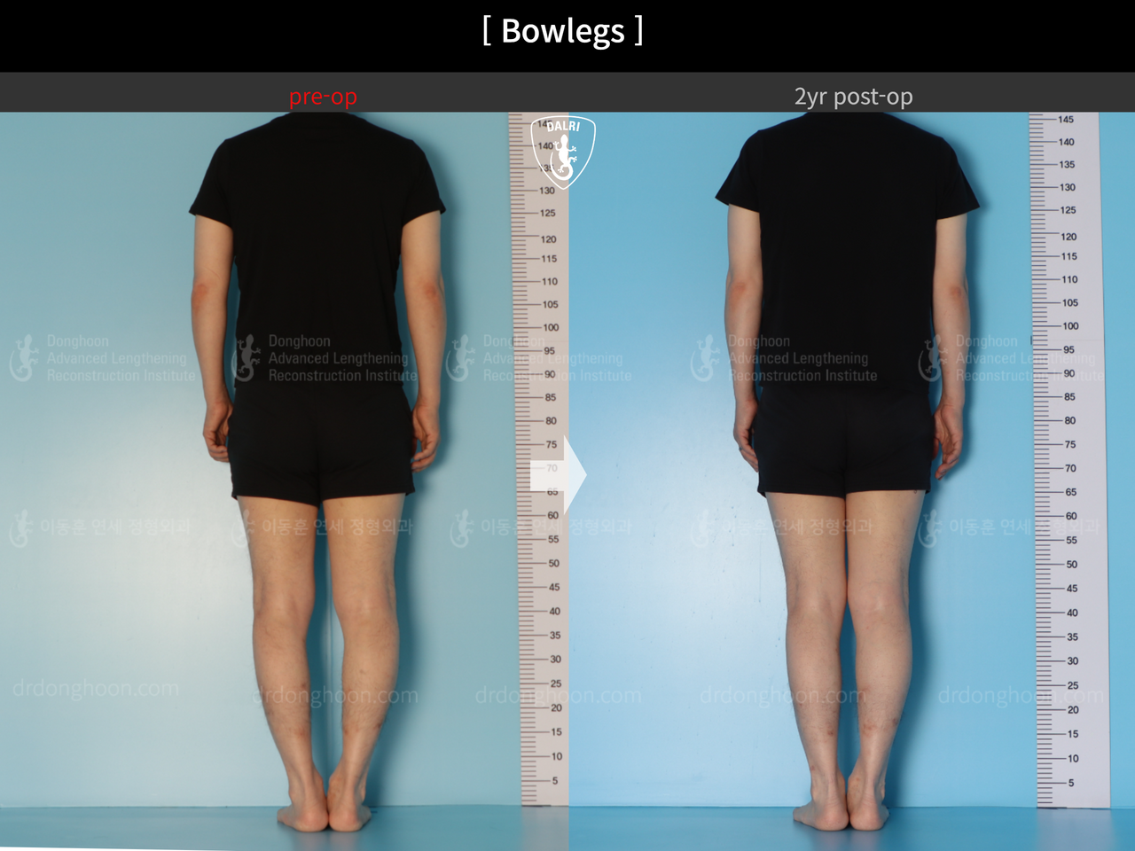 Before and after adult bowlegs, case 14445187, image 2, Dr. Donghoon institute (DALRI)