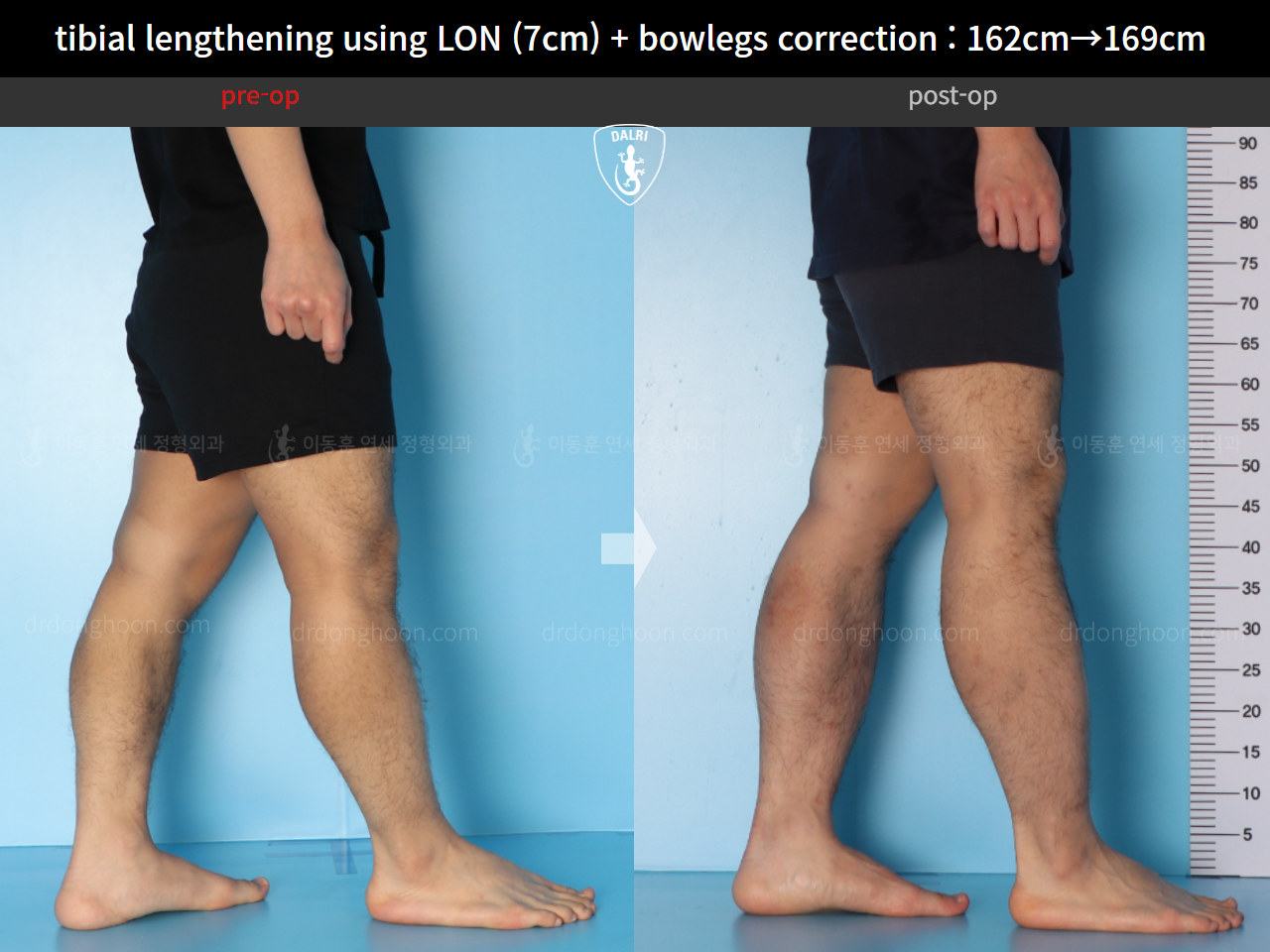 Before and after cll + deformity correction, case 15545055, image 7, Dr. Donghoon institute (DALRI)