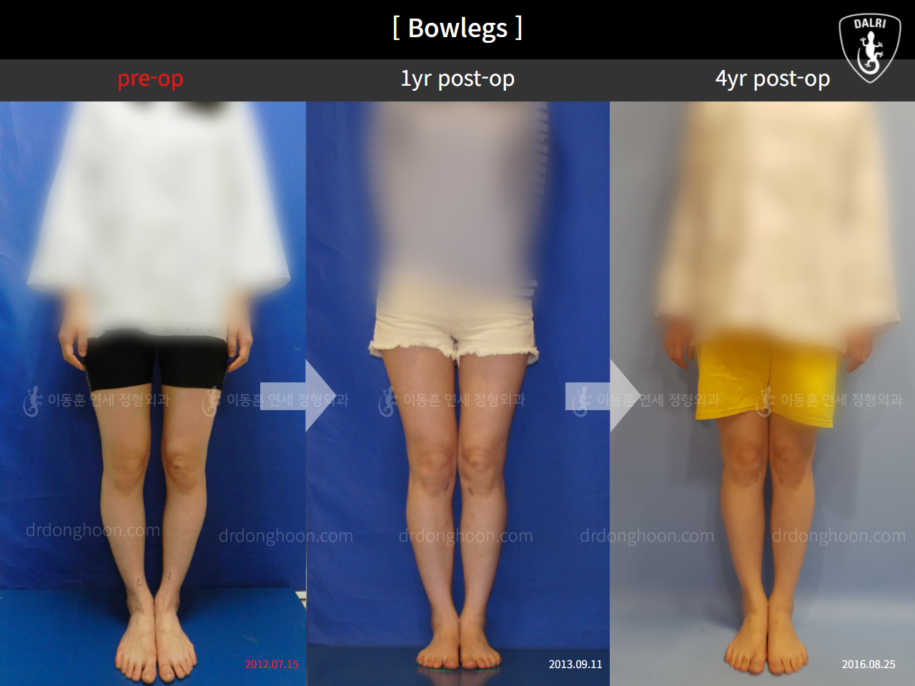 Before and after adult bowlegs, case 4310976, image 1, Dr. Donghoon institute (DALRI)