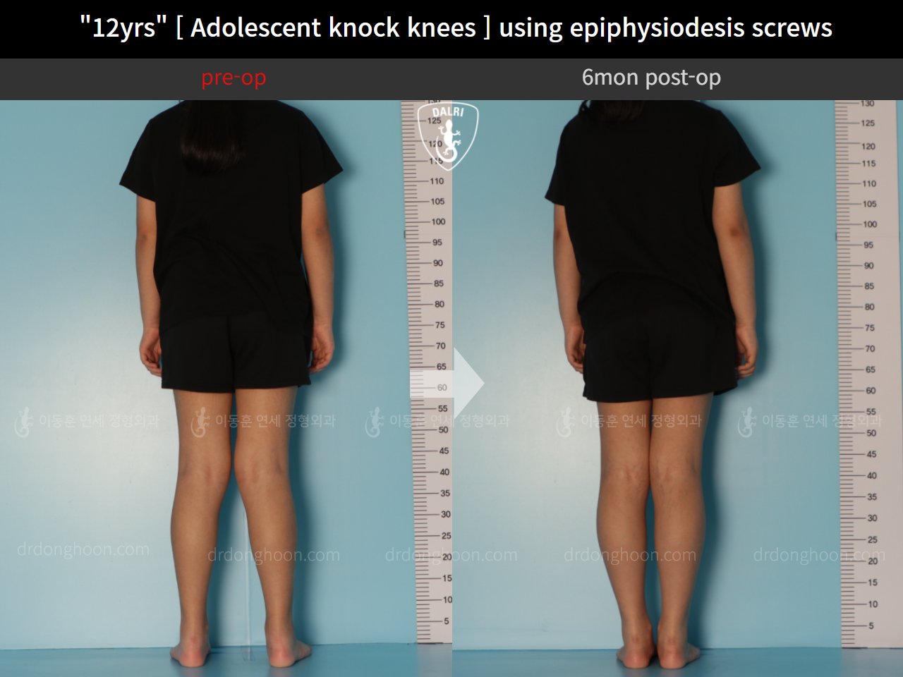 Before and after paediatric & adolescent knock knees, case 11772990, image 2, Dr. Donghoon institute (DALRI)