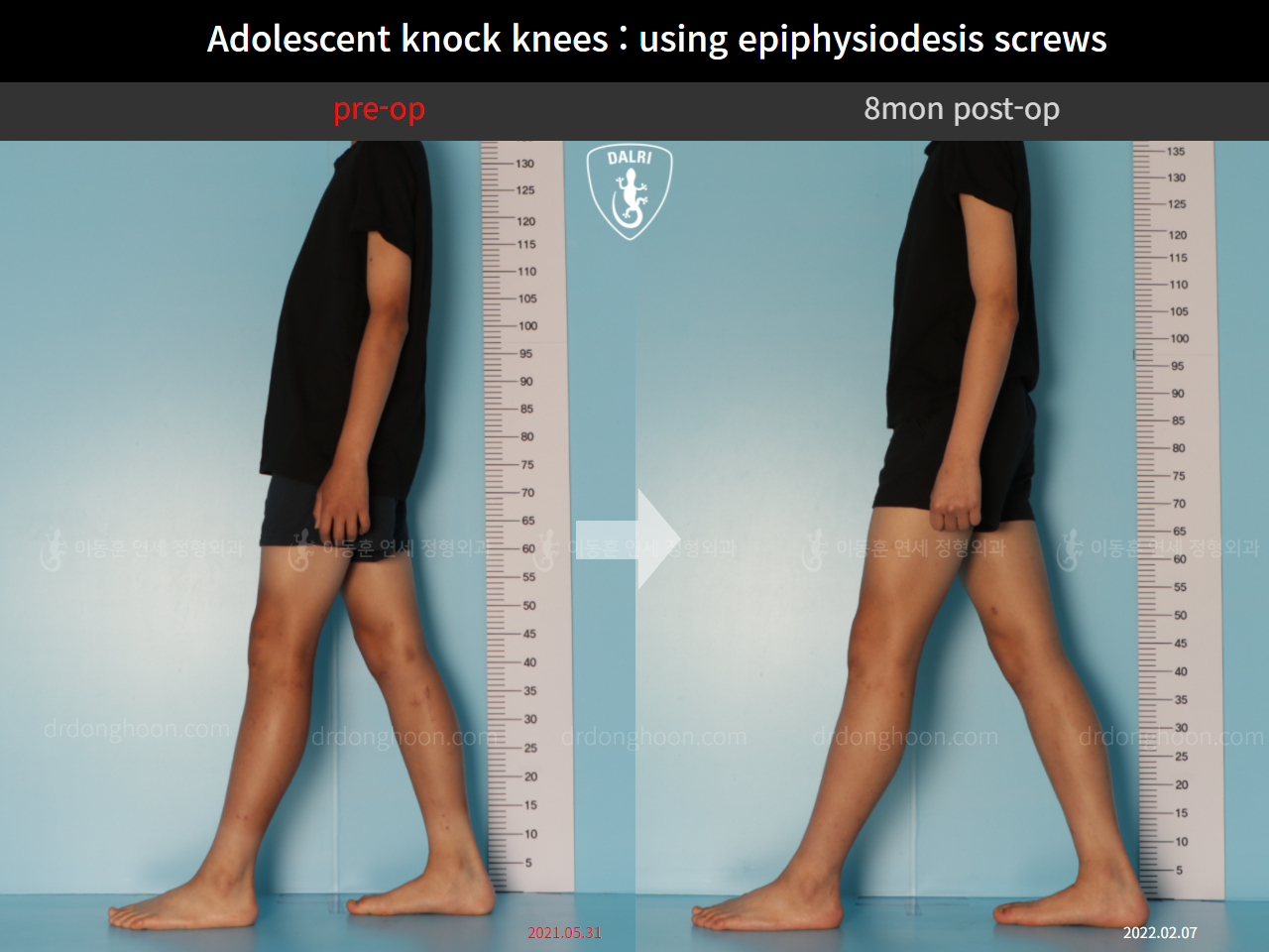 Before and after paediatric & adolescent knock knees, case 10171145, image 6, Dr. Donghoon institute (DALRI)