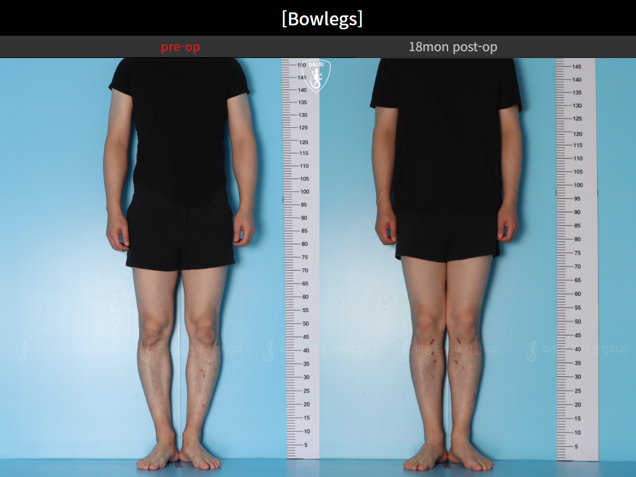 Before and after adult bowlegs, case 94769040, image 4, Dr. Donghoon institute (DALRI)