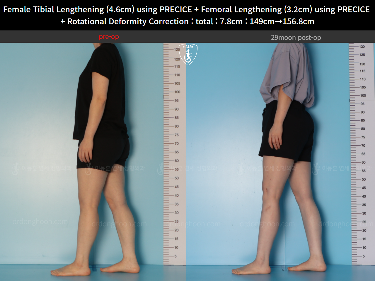 Before and after cll precice, case 123686647, image 5, Dr. Donghoon institute (DALRI)