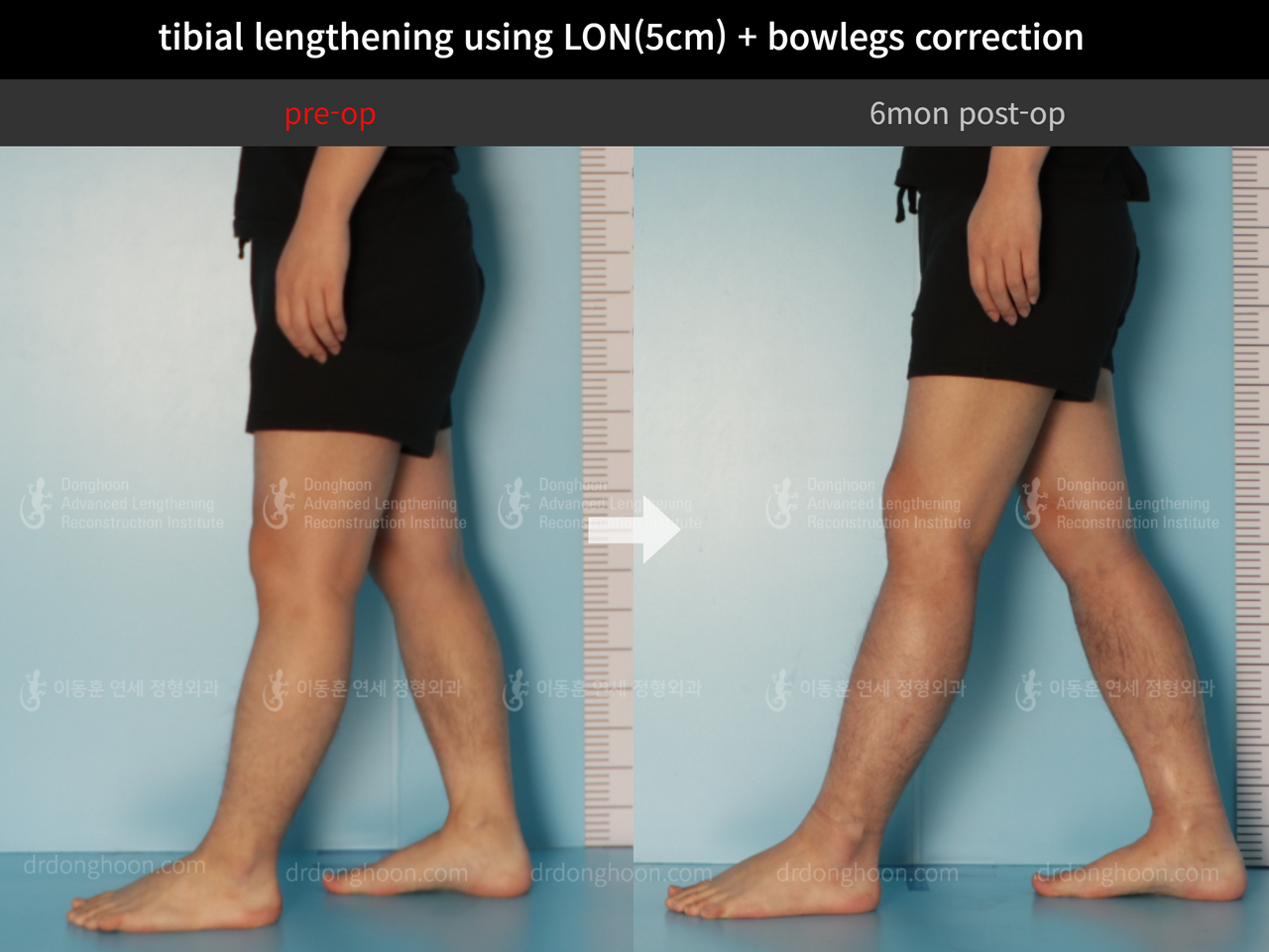 Before and after cll + deformity correction, case 11925306, image 8, Dr. Donghoon institute (DALRI)