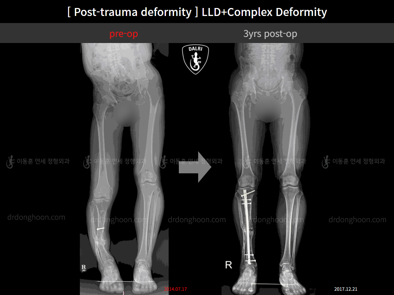 Before and after post-trauma deformity, case 11774747, image 1, Dr. Donghoon institute (DALRI)