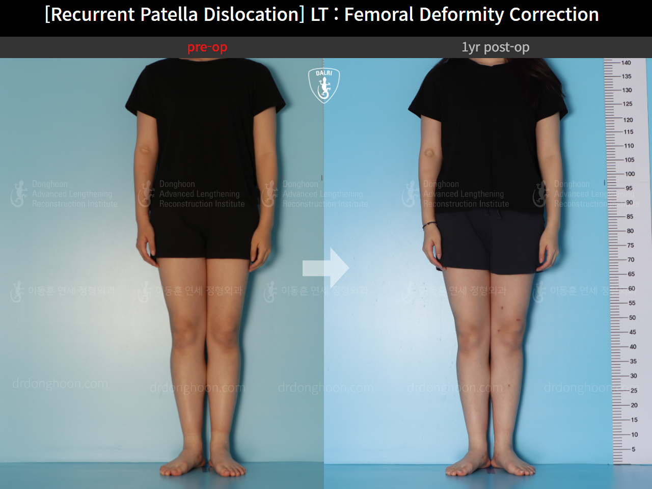 Before and after recurrent patella dislocation, case 15125370, image 3, Dr. Donghoon institute (DALRI)