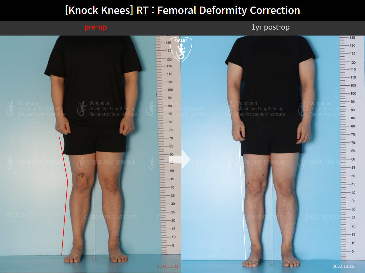 Before and after adult knock knees, case 15950751, image 1, Dr. Donghoon institute (DALRI)