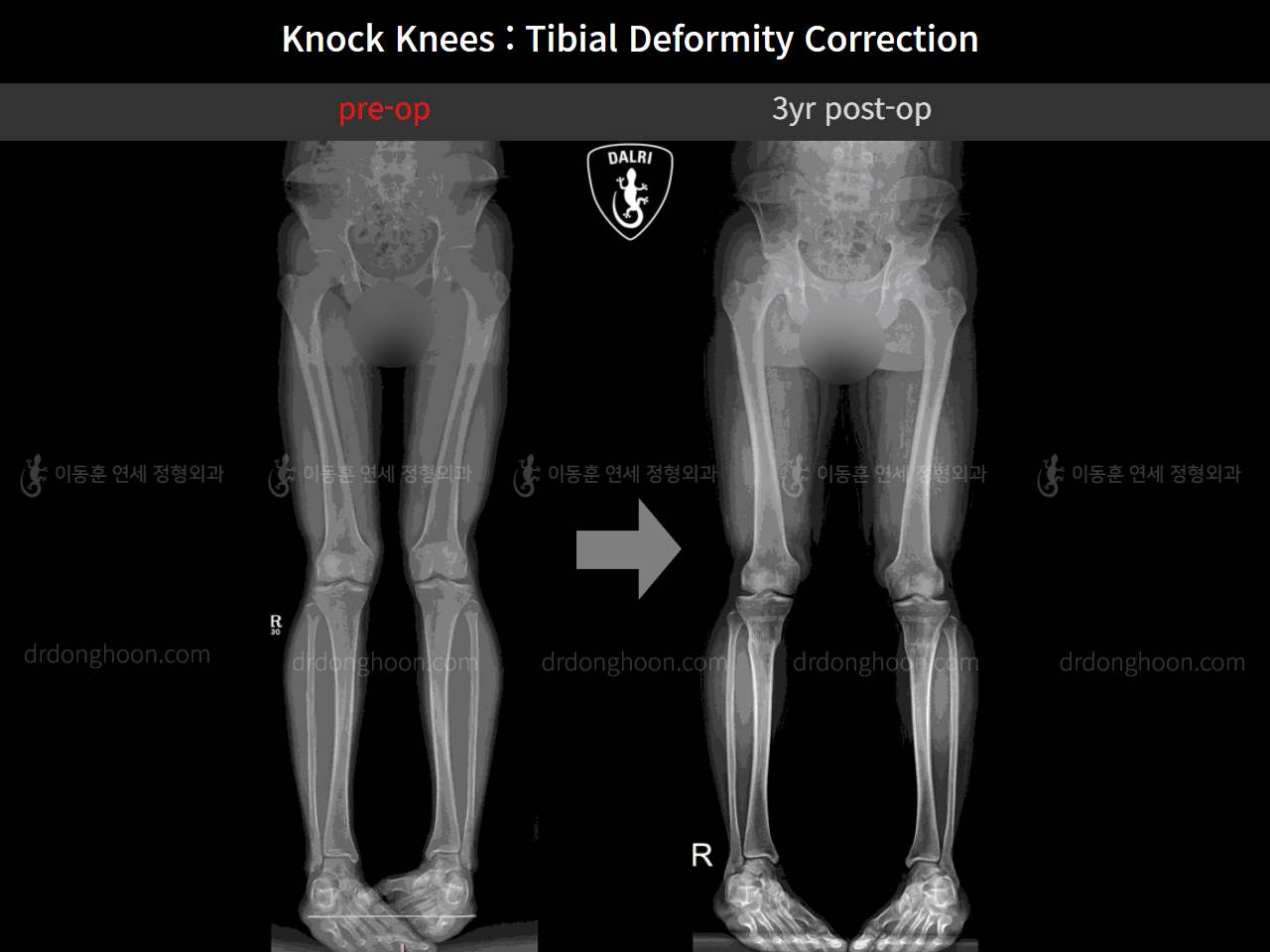 Before and after adult knock knees, case 11468369, image 6, Dr. Donghoon institute (DALRI)