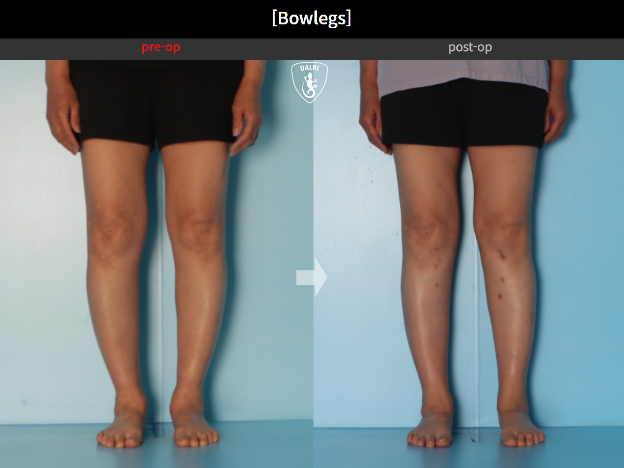 Before and after adult bowlegs, case 30770070, image 9, Dr. Donghoon institute (DALRI)