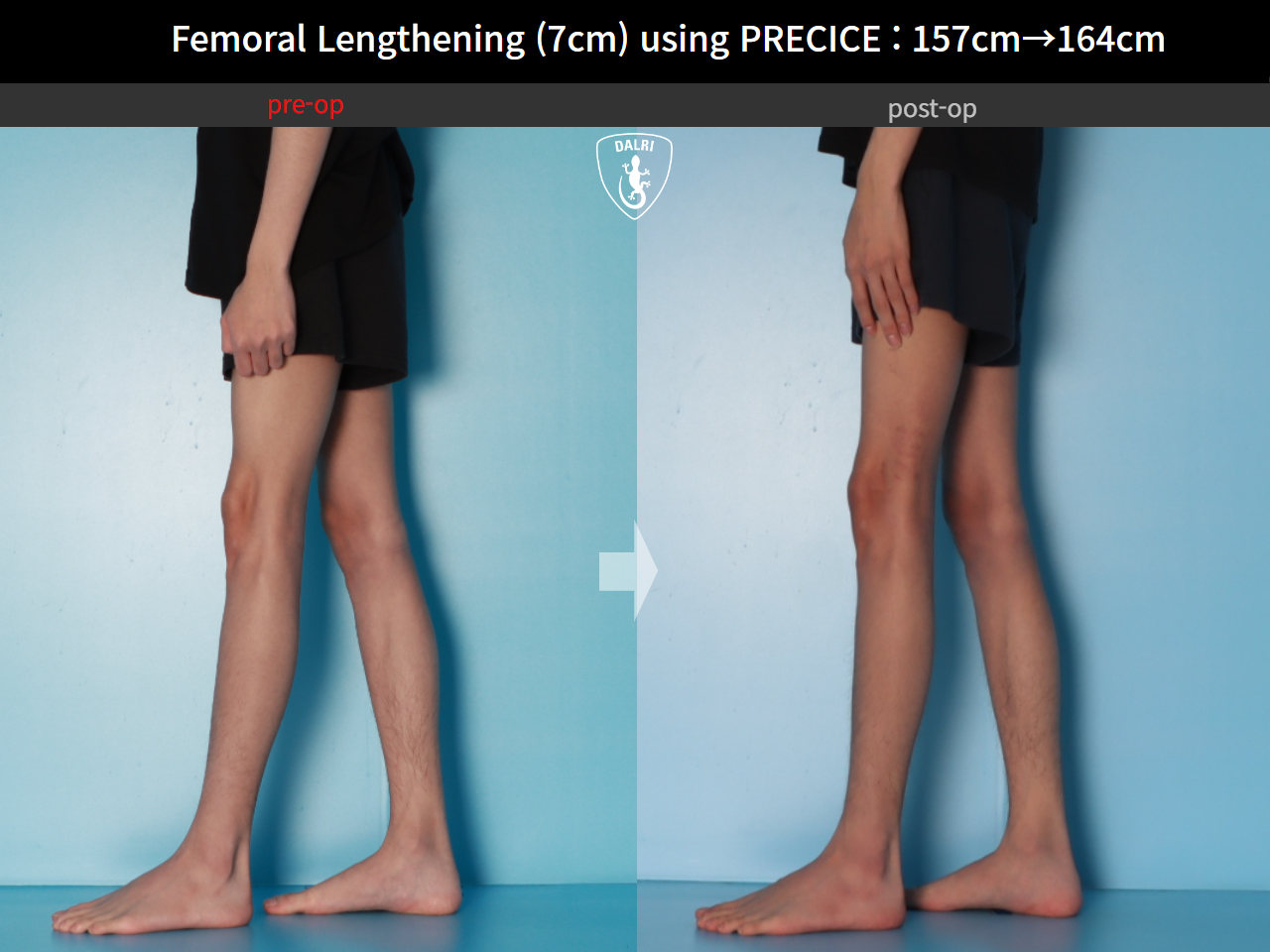 Before and after cll precice, case 31554406, image 9, Dr. Donghoon institute (DALRI)