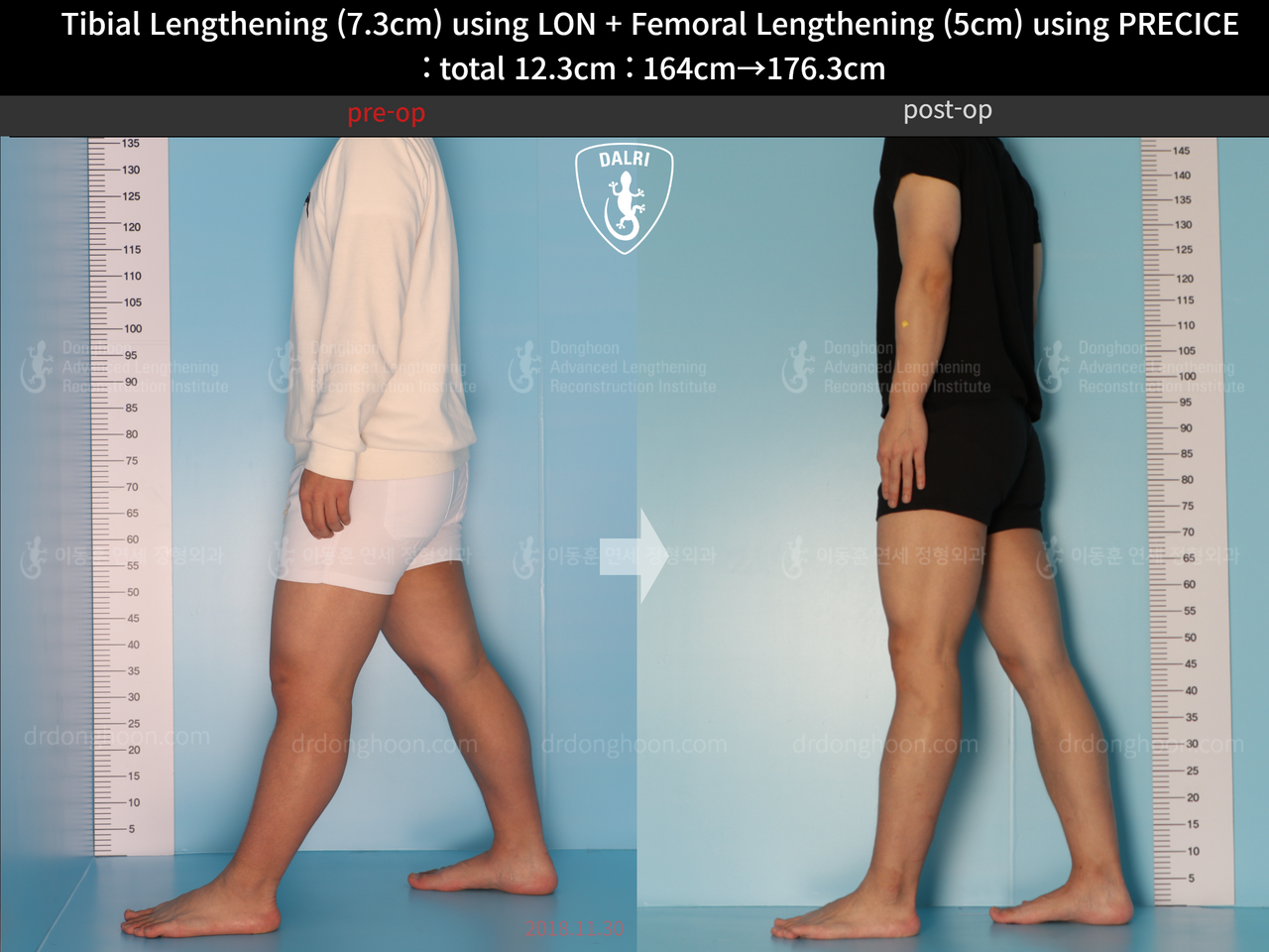 Before and after cll precice, case 13590455, image 3, Dr. Donghoon institute (DALRI)
