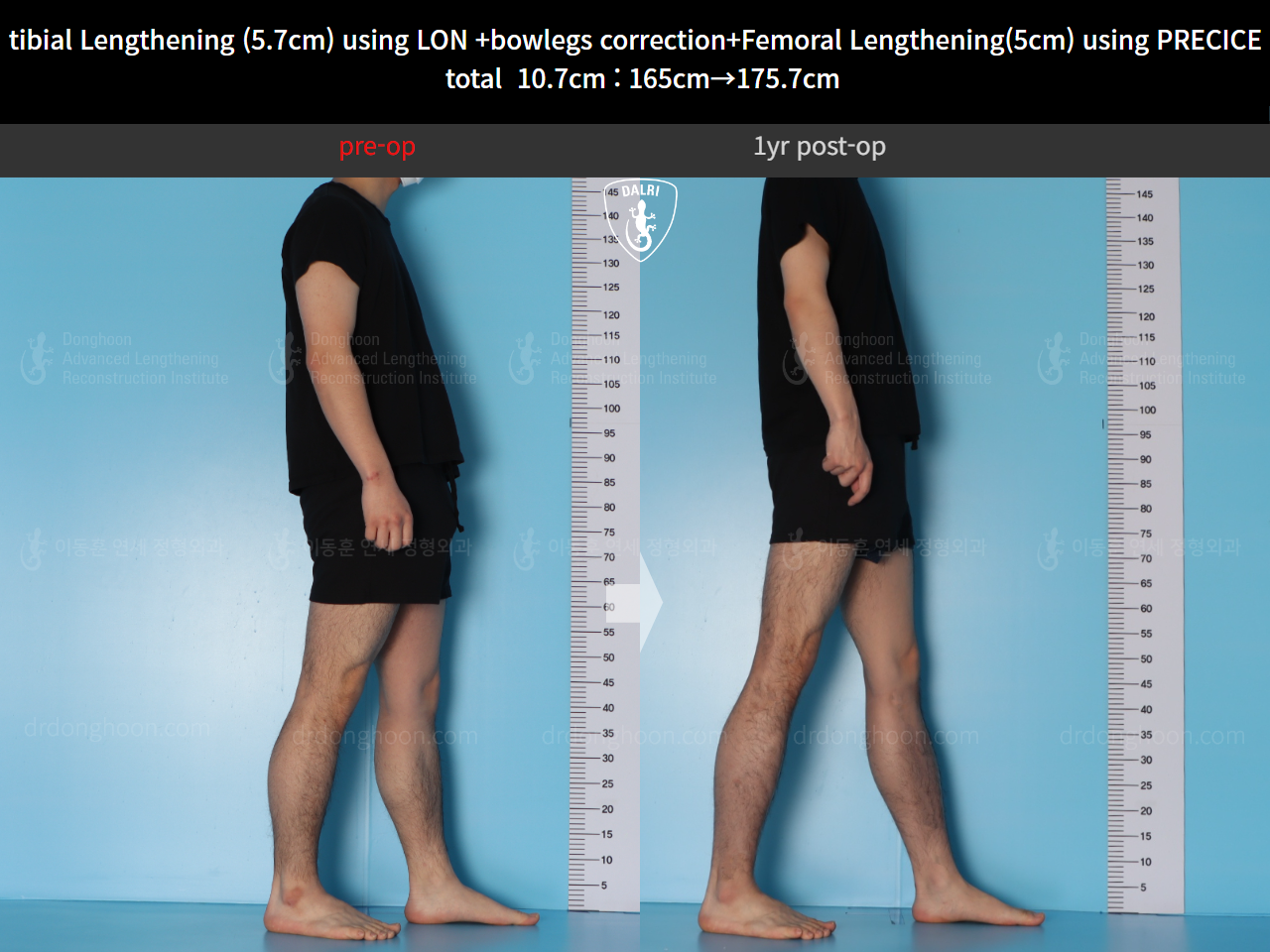 Before and after cll precice, case 20363375, image 6, Dr. Donghoon institute (DALRI)