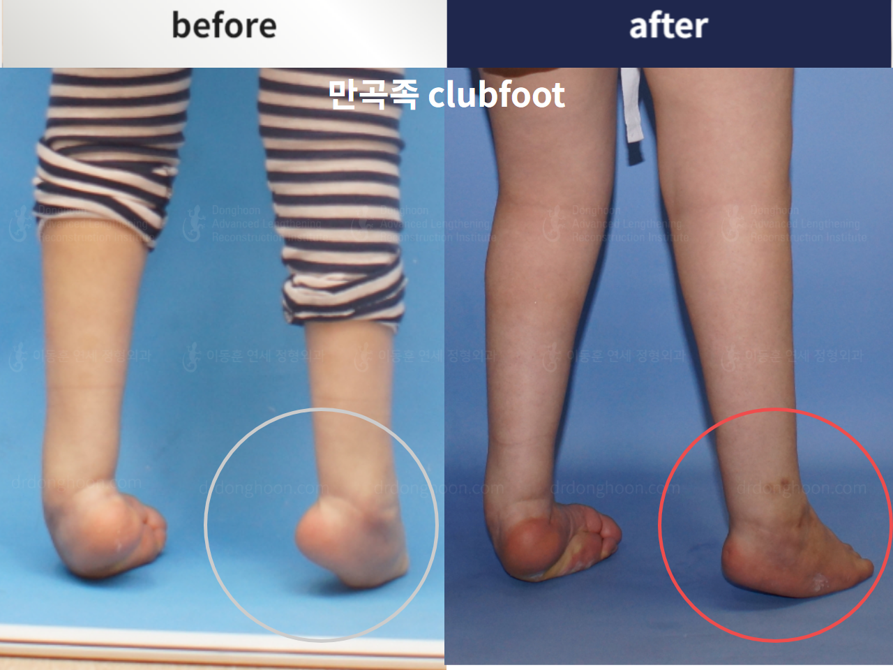 Before and after paediatric congenital condition, case 4304688, image 2, Dr. Donghoon institute (DALRI)