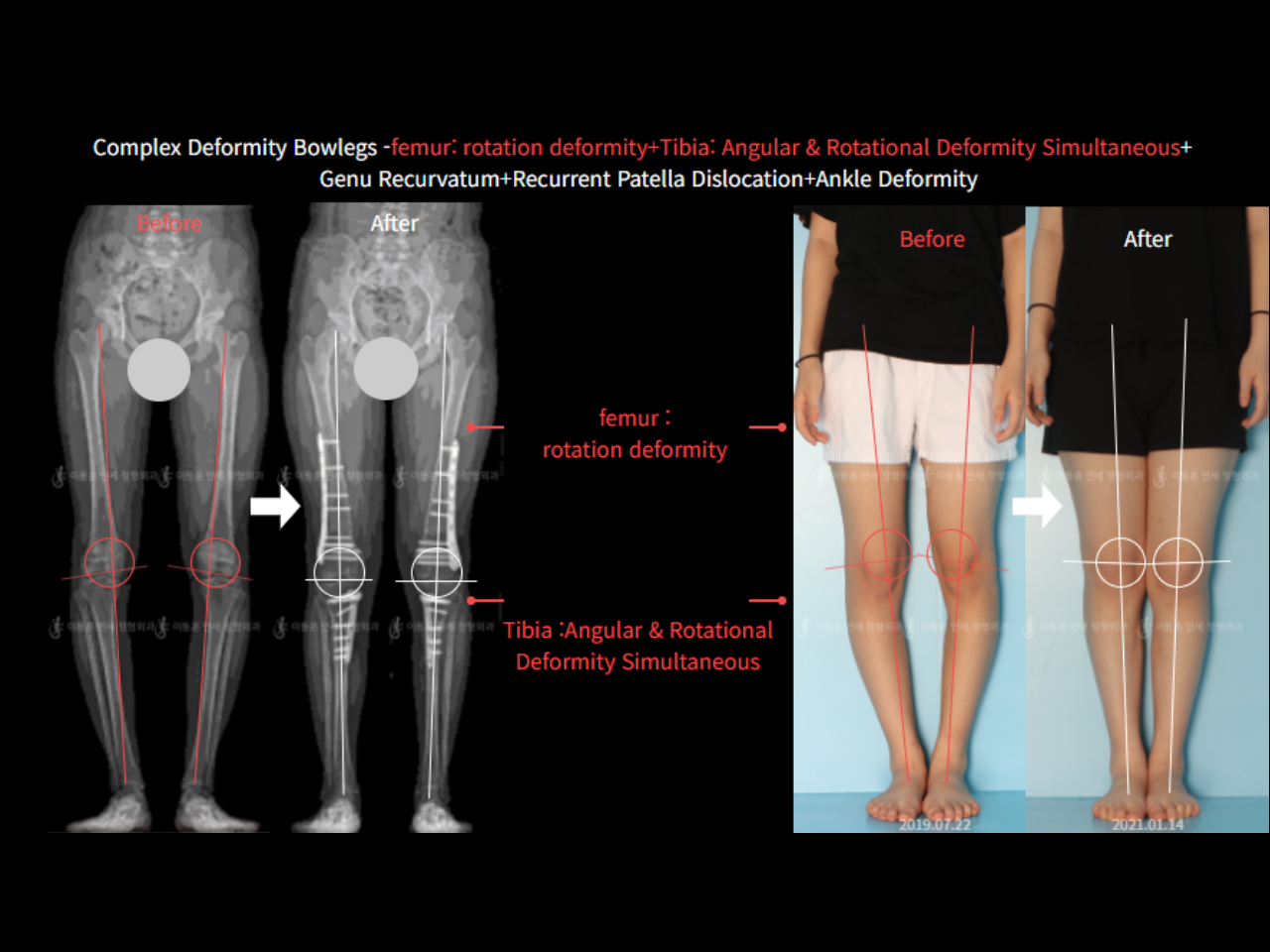 Before and after adult bowlegs, case 6883070, image 3, Dr. Donghoon institute (DALRI)
