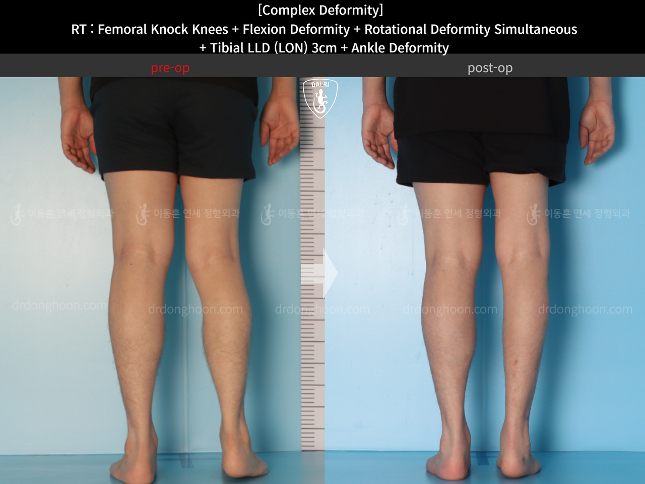 Before and after complex deformity, case 14286599, image 6, Dr. Donghoon institute (DALRI)