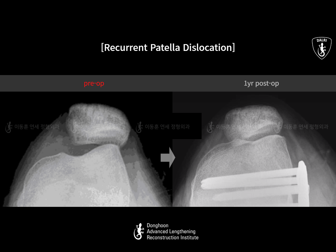 Before and after recurrent patella dislocation, case 15125370, image 9, Dr. Donghoon institute (DALRI)