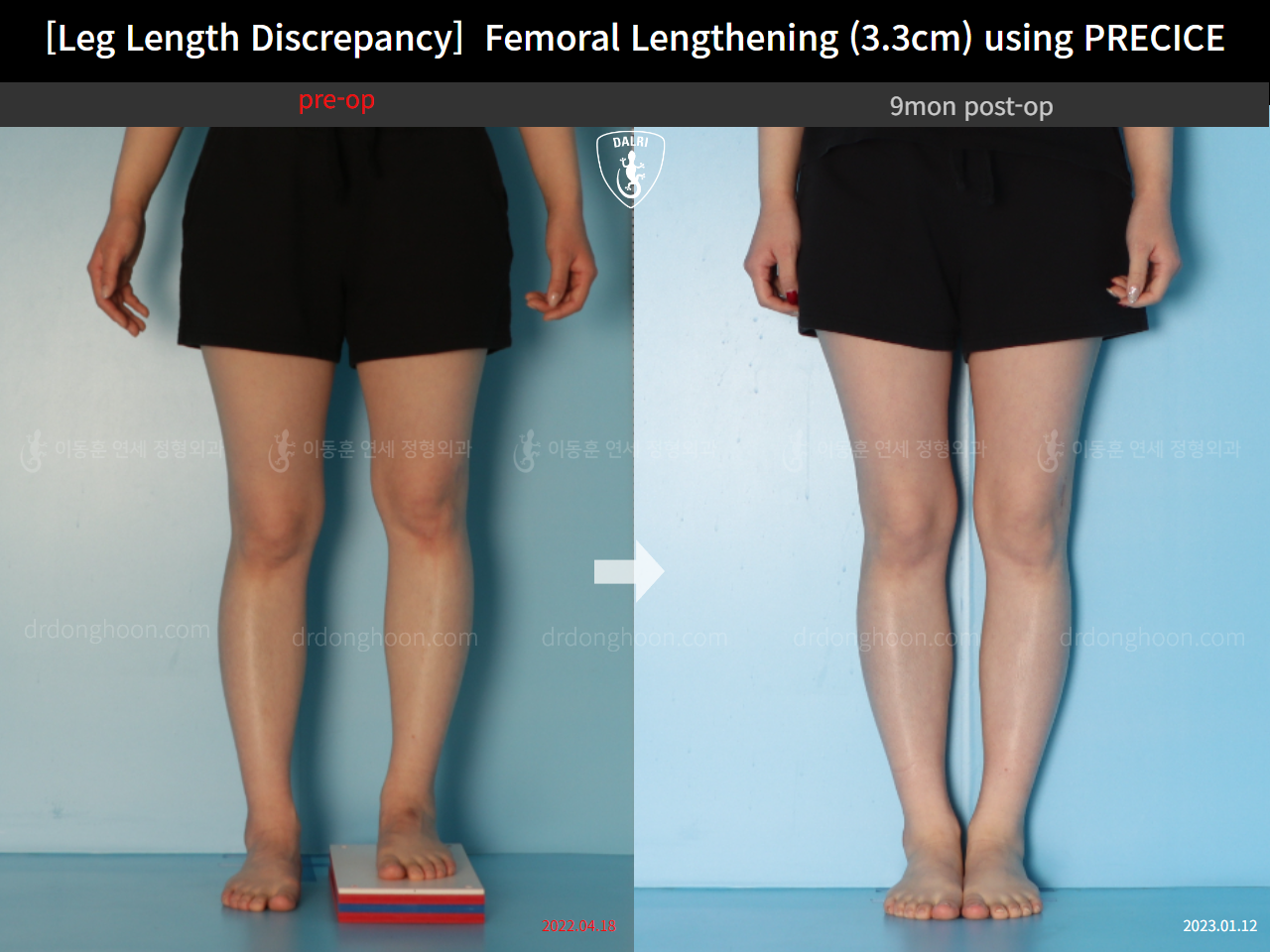 Before and after adult lld, case 14602297, image 5, Dr. Donghoon institute (DALRI)