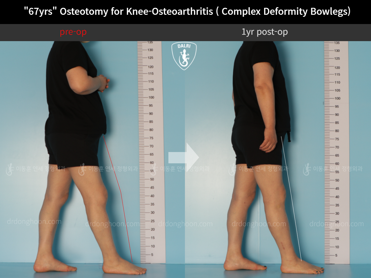 Before and after osteotomy for knee osteoarthritis, case 11339432, image 3, Dr. Donghoon institute (DALRI)