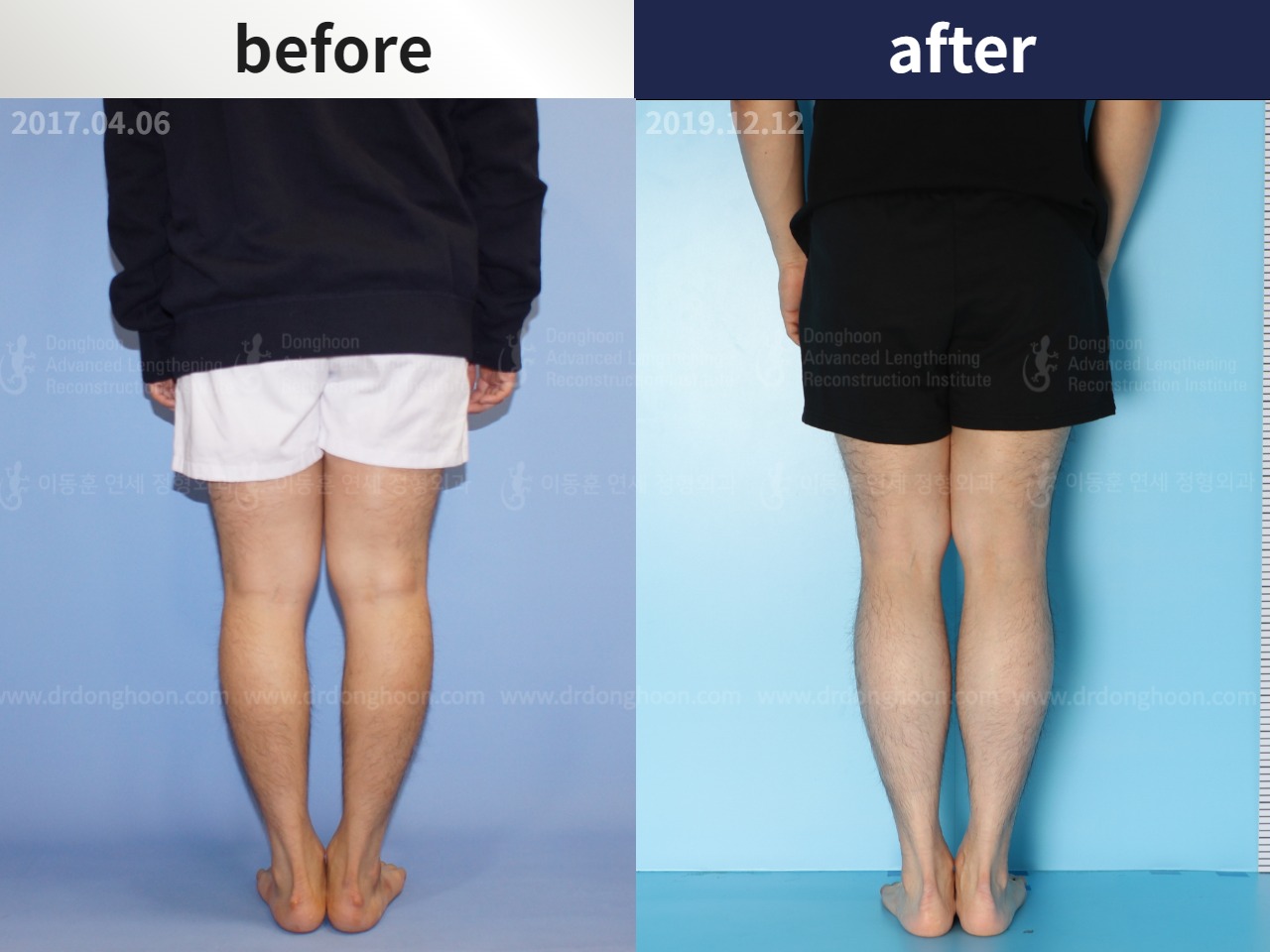 Before and after cll + deformity correction, case 4585650, image 2, Dr. Donghoon institute (DALRI)