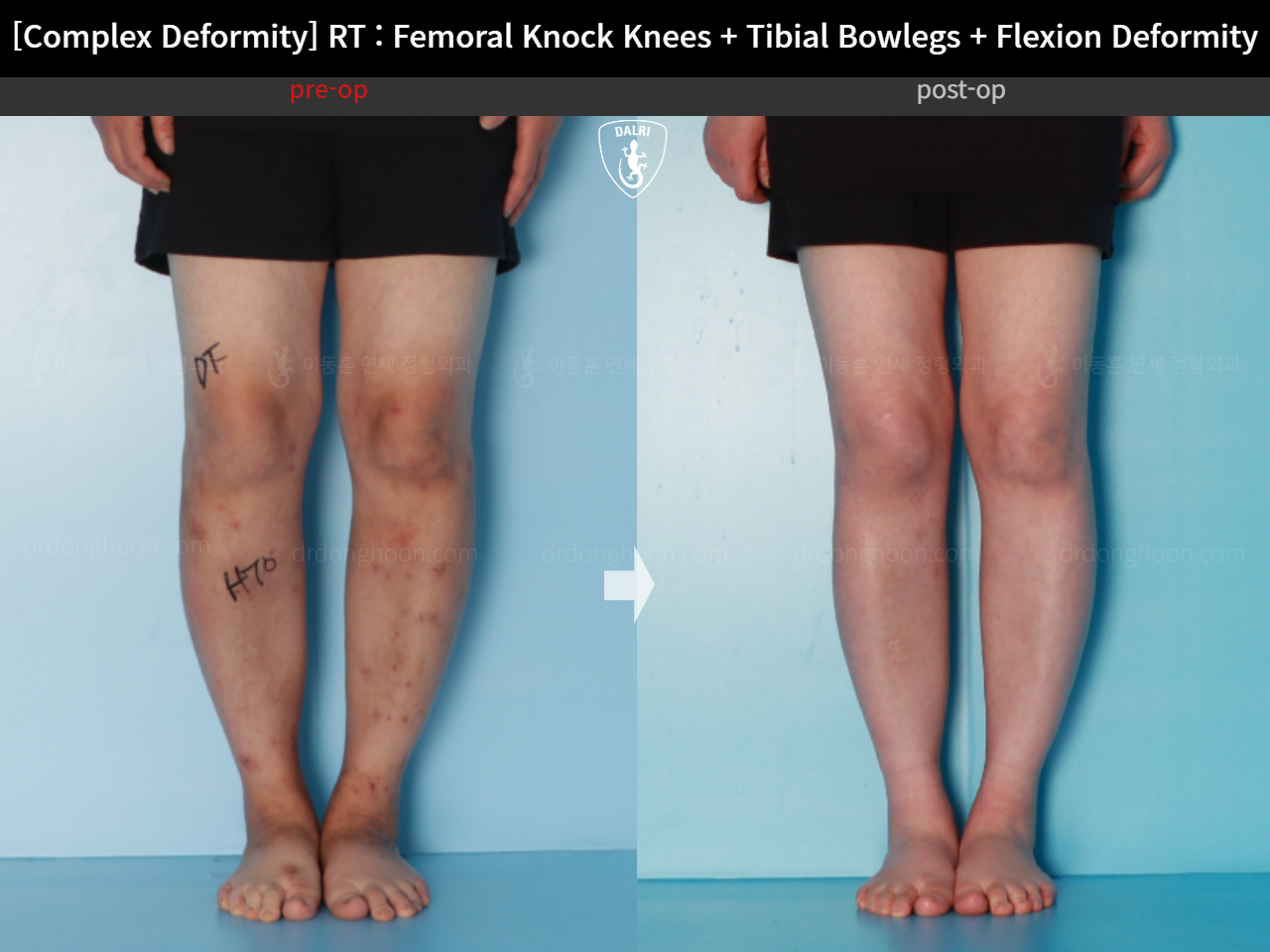 Before and after complex deformity, case 16507040, image 6, Dr. Donghoon institute (DALRI)