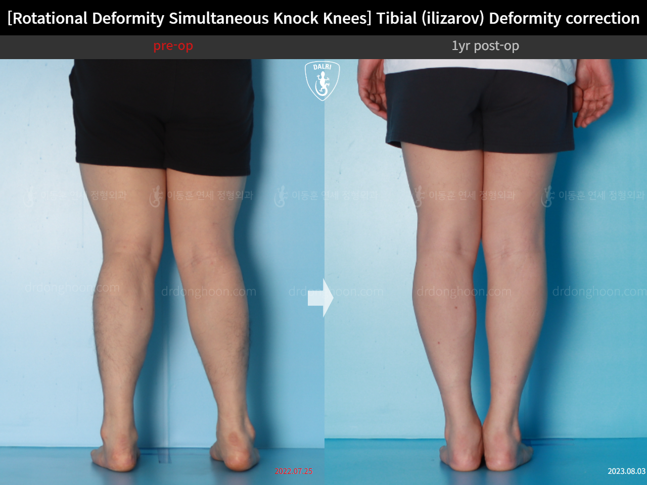 Before and after adult knock knees, case 15977455, image 7, Dr. Donghoon institute (DALRI)