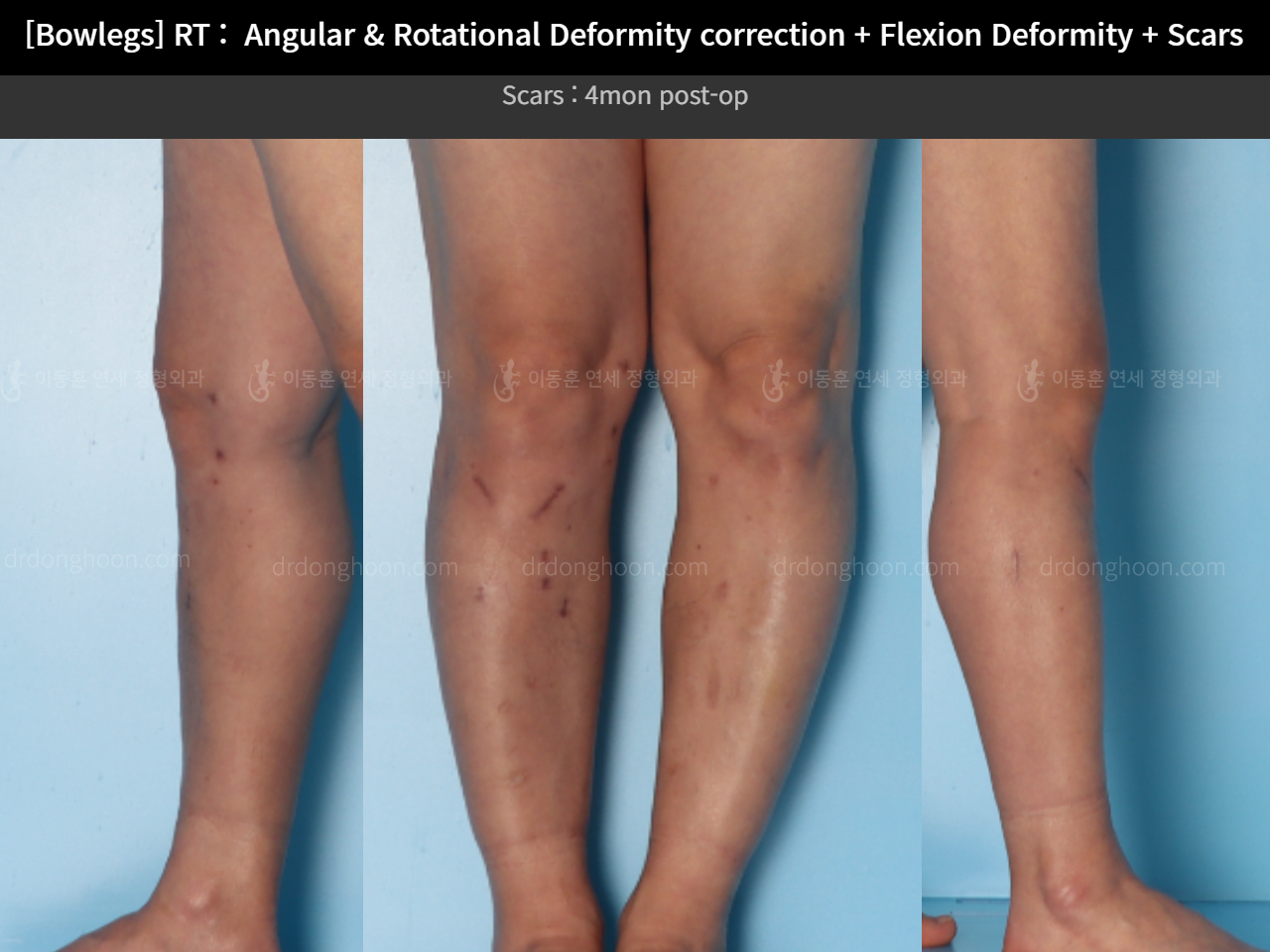 Before and after adult bowlegs, case 14701830, image 10, Dr. Donghoon institute (DALRI)