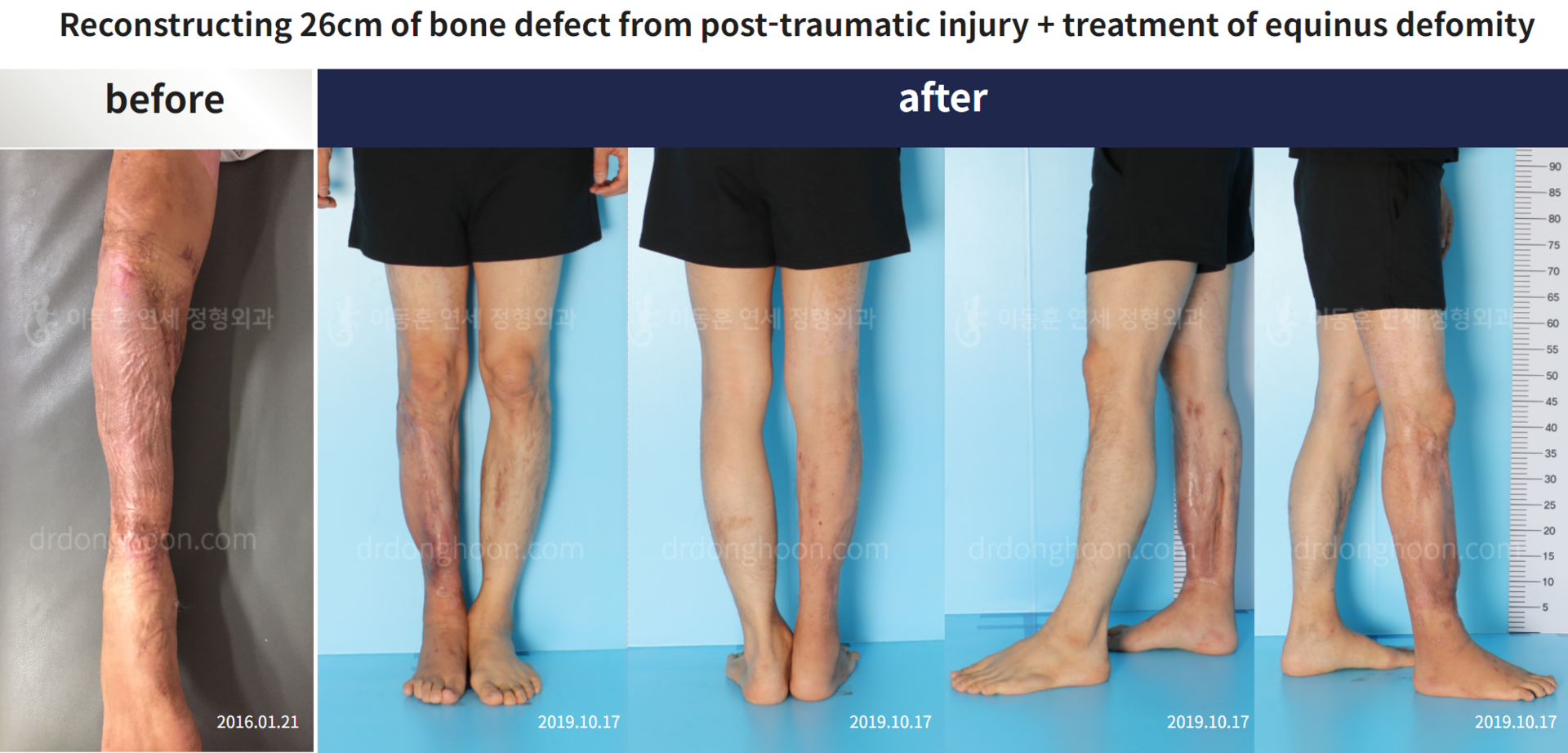 Before and after re-operation for cll, case 5200498, image 4, Dr. Donghoon institute (DALRI)