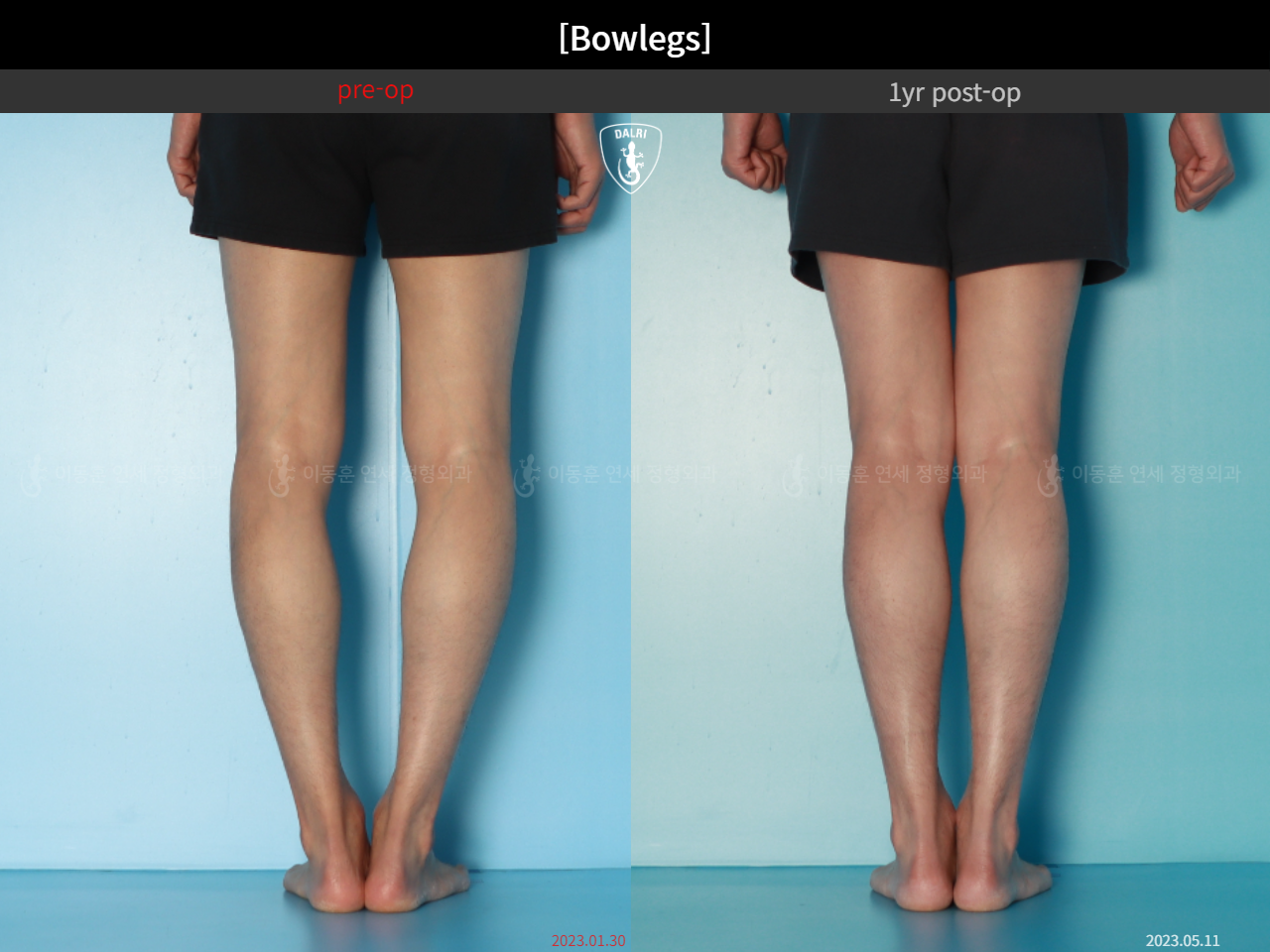 Before and after adult bowlegs, case 32564251, image 12, Dr. Donghoon institute (DALRI)