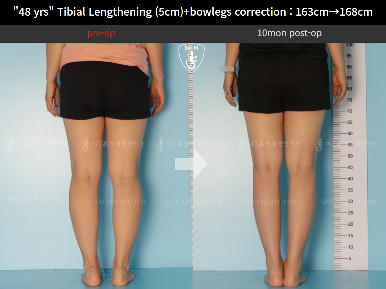 Before and after cll precice, case 10474341, image 6, Dr. Donghoon institute (DALRI)