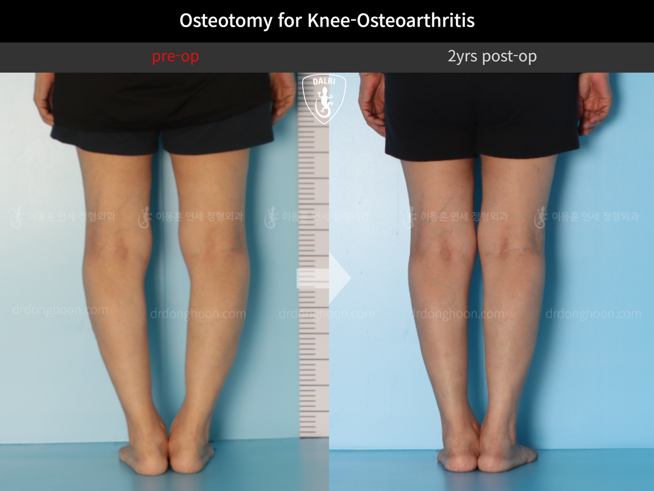 Before and after osteotomy for knee osteoarthritis, case 12844528, image 6, Dr. Donghoon institute (DALRI)