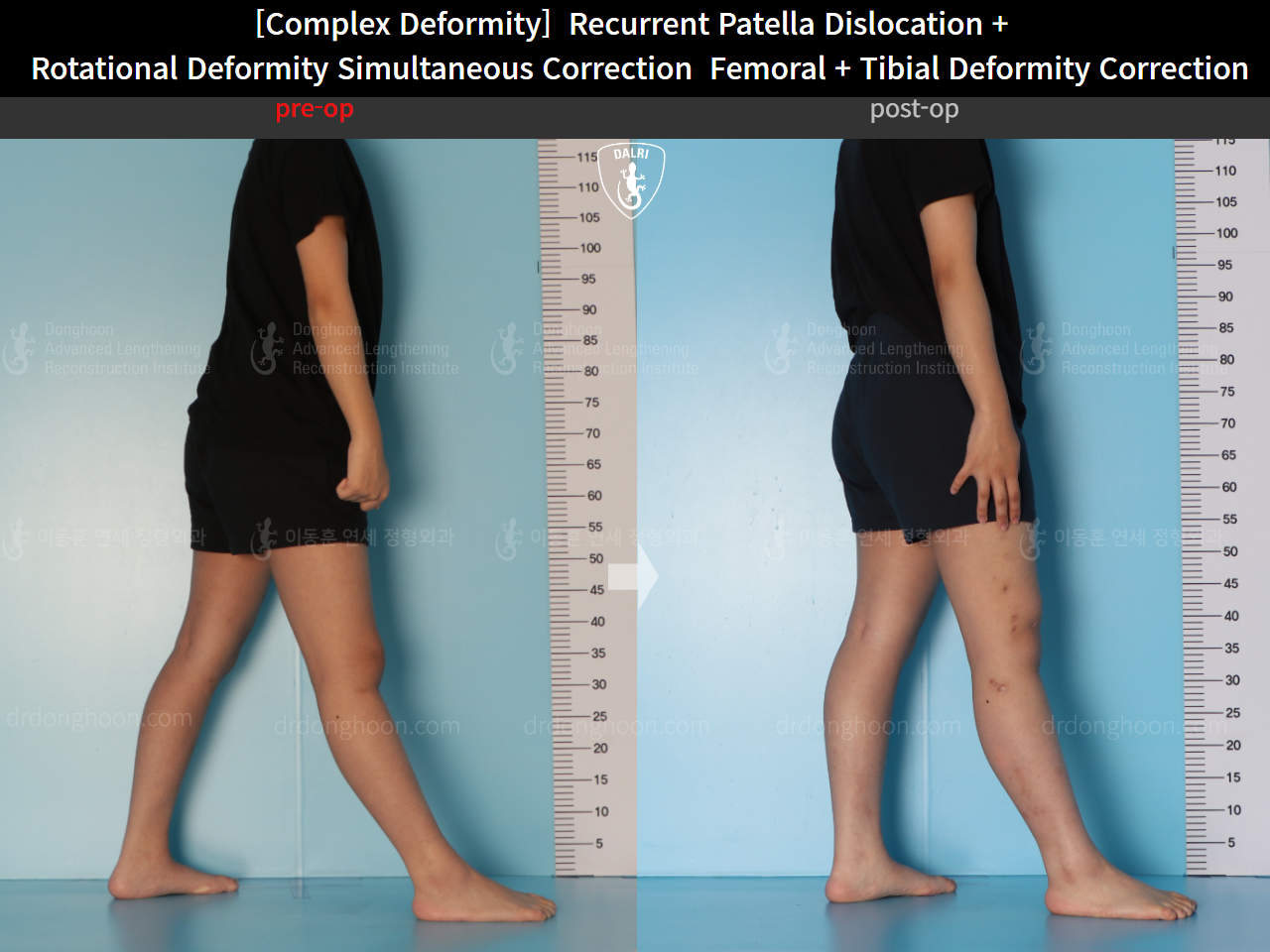Before and after recurrent patella dislocation, case 16298897, image 5, Dr. Donghoon institute (DALRI)