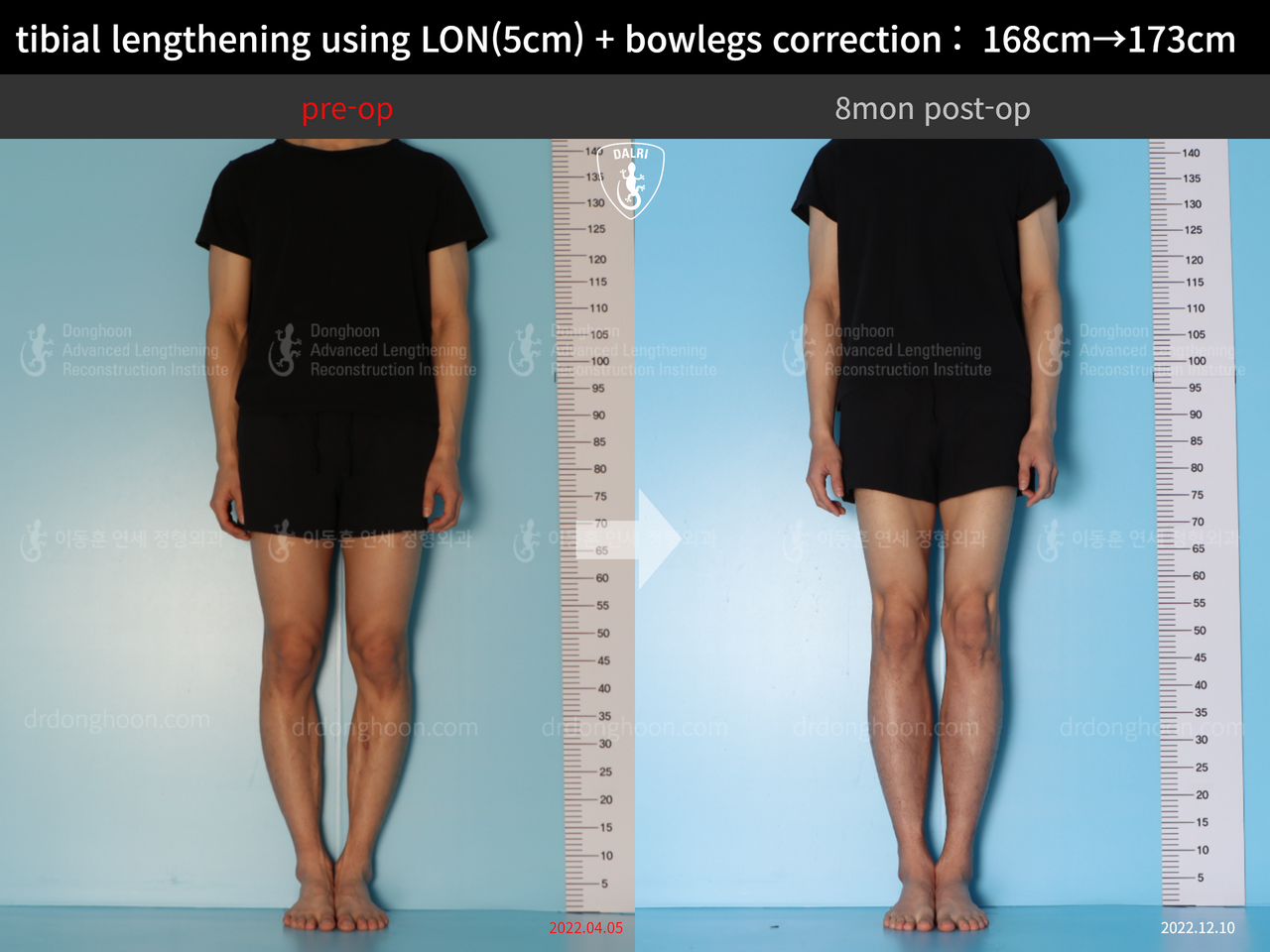 Before and after cll + deformity correction, case 13661181, image 1, Dr. Donghoon institute (DALRI)