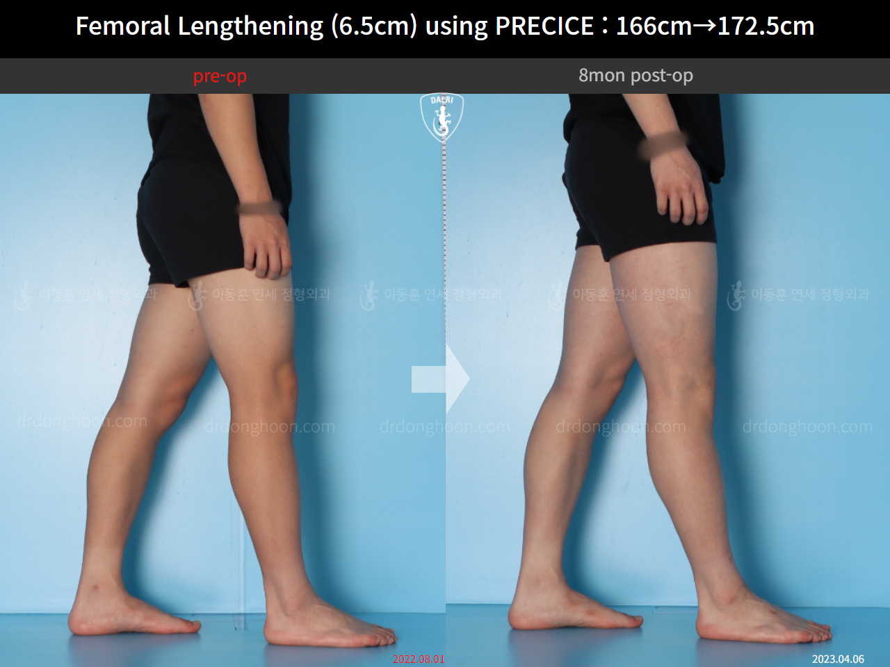 Before and after cll precice, case 14706614, image 12, Dr. Donghoon institute (DALRI)