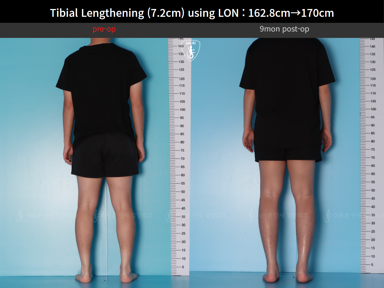 Before and after cll lon, case 124820559, image 4, Dr. Donghoon institute (DALRI)